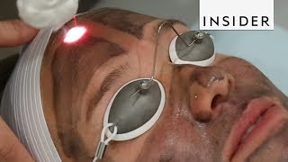 Get Glowing Skin With A Laser Facial [upl. by Meingolda]