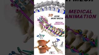 K2M Mini Mesa medical animation 3d short Biology with Aliya [upl. by Noellyn]