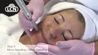 Micro Needling Tutorial mit dem Mobile Pen und Tipps von LCN [upl. by Hillman]