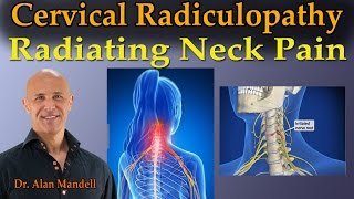 Cervical Radiculopathy Radiating Neck Pain  Dr Mandell Live Stream [upl. by Aerdnas]