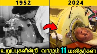 உறுப்புகளின்றி வாழும் 11 வினோத மனிதர்கள்  Unique People With Missing Body Parts  Tamil Ultimate [upl. by Rinna]