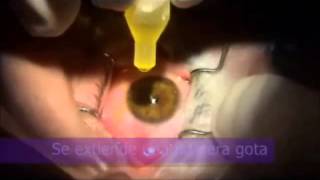 Técnica Crosslinking Corneal para pacientes con Queratocono realizada en Clínica Coro [upl. by Knight343]