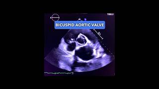 What does a Bicuspid Aortic Valve look like echocardiography cardiology echocardiogram [upl. by Cynthea]