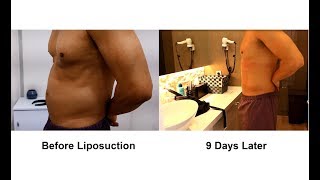 Tony Gets Liposuction in Korea  Part 1 of 3  Seoul Guide Medical [upl. by Ailec]