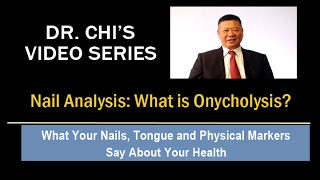 Dr Chis Fingernail and Tongue Analysis  Onycholysis [upl. by Airetak]