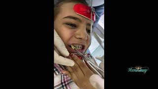 orthodontic facemask installation [upl. by Kinzer123]