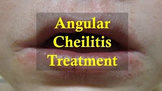 How to cure Angular Cheilitis Naturally [upl. by Anigger825]