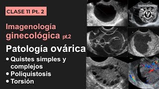 112  Imagenología de los ovarios Quistes simples y complejos poliquistosis y torsión [upl. by Jodie]