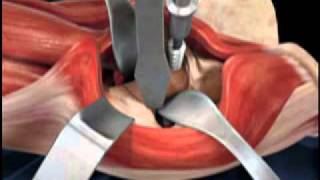 Depuy Direct Anterior Total Hip Replacement Animated Video [upl. by Seilenna]