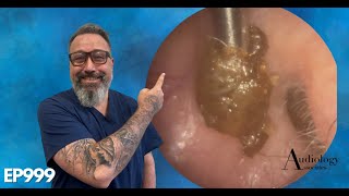 Removing a chunky ear wax plug from an ear  EP999 [upl. by Niela]