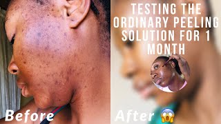 The ordinary peeling solution 4 weeks review with before amp after tik tok made me do it [upl. by Salim855]