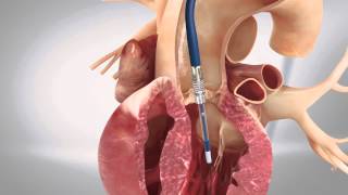 TAVI transfemoral  Transcatheter Aortic Heart Valve  3D Animation Medizin [upl. by Snowman]