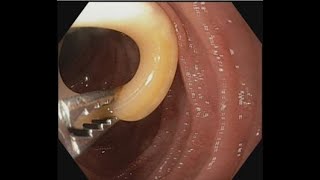 Ascariasis Removal from papilla BDENDOSCOPY [upl. by Crenshaw]