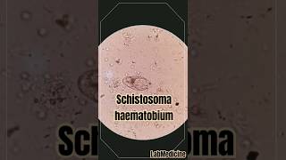 Schistosoma haematobium in urine  Clinical Parasitology [upl. by Mccullough]