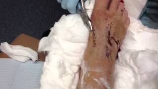 Lisfranc Dislocation Kwire removal [upl. by Bierman]