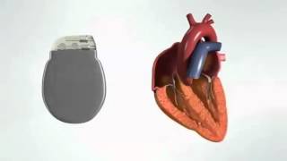 Implantation dun Pacemaker [upl. by Ul]