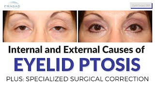 Differentiating Types of Eyelid Ptosis and its Specialized Surgical Correction [upl. by Annairdna682]