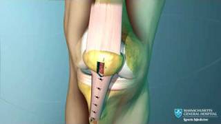 Anterior Cruciate Ligament ACL Reconstruction Animation [upl. by Sidnac]