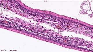 High Grade Serous Carcinoma of Ovary  Pathology mini tutorial [upl. by Haidadej]