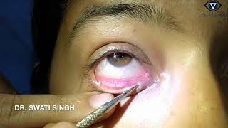 Lacrimal Syringing Technique and Interpretation [upl. by Melisse]