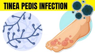 Tinea Pedis Infection Athletes Foot  Causes Types Signs amp Symptoms And Treatment [upl. by Emlynne221]