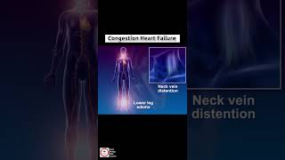 Congestive Heart Failure CHF  cardiology [upl. by Onaivlis]