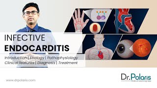 INFECTIVE ENDOCARDITIS  Etiology Pathophysiology Clinical Features Management  Animated [upl. by Artus]