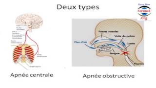 Faites Vous des Apnées de Sommeil [upl. by Sleinad]