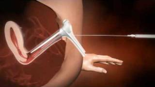 3D animation of how IUI works [upl. by Arrio]