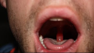 swollen throat clinical case answer and discussion [upl. by Catie]