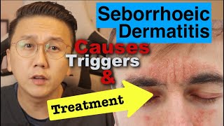 Seborrhoeic Dermatitis  Causes Triggers amp Treatment Options [upl. by Ynittirb663]