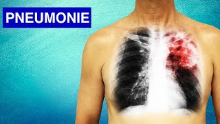 Pneumonie  Symptômes Diagnostic et Traitements [upl. by Ynaittirb256]