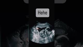 Baby farting sonography shortsfeed [upl. by Iroc858]