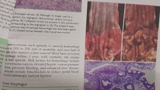 Barrett Esophagus  SPECIAL PATHOLOGY [upl. by Ttnerb]