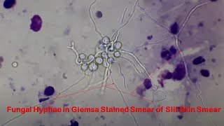 Fungal hyphae in GiemSa stained slit skin smear under the Microscope [upl. by Lebam]