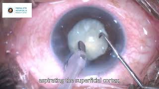 Complicated Mature Cataract  Uveitic Cataract  Dr Ashish K Jain  MEHRC Malad Mumbai [upl. by Olcott265]