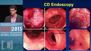 Confirming the Diagnosis Extent and Severity of IBD [upl. by Raddie]