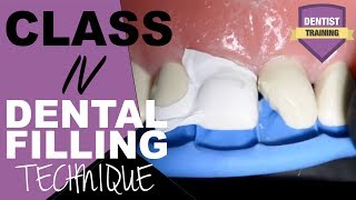 Class IV Composite Filling Tutorial  Front Tooth Filling [upl. by Hteboj298]