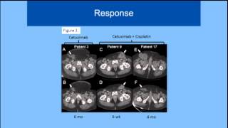 EGFRtargeted therapy for advanced penile or scrotal cancer [upl. by Juster]