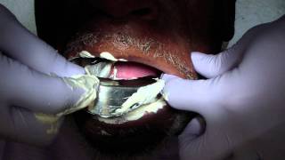 Removable Denture Clasp Repair Part 2  Alginate Pickup Impression [upl. by Aztiram]