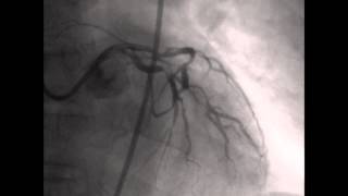 Coronary angiography CAG [upl. by Wasson]