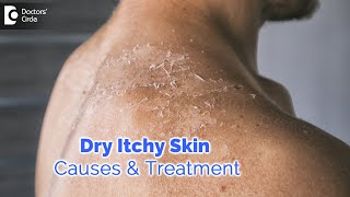 Dry itchy skin all over body Causes Diagnosis Treatment  Dr Rashmi Ravindra  Doctors Circle [upl. by Quintus]