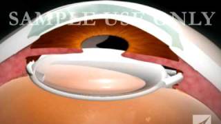 Eye Surgery Cataract with Lens Replacement [upl. by Kinnie]