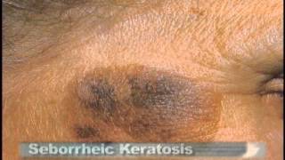 Common Skin Lesions [upl. by Nnairrehs]