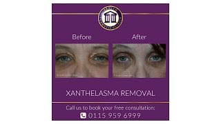 Xanthelasma Removal with Dr Maini [upl. by Dollie483]