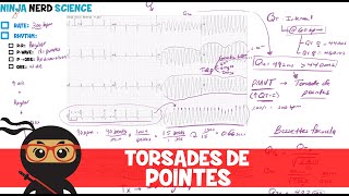 Rate and Rhythm  Torsades de Pointes [upl. by Ephrem897]