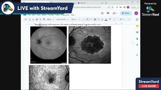 2 papilledema stages cf lab investigations pseudo papilledema [upl. by Latvina]