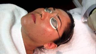 Erbium Laser Peel Of FaceLos AngelesOrange CountySan Gabriel Valley [upl. by Safoelc]