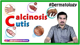 Calcinosis cutis  Dermatology clinicalessentials [upl. by Jacklin524]