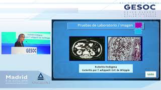 Escleritis infecciosas [upl. by Ettore]